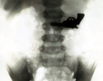 x ray 1
