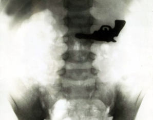 x ray 1